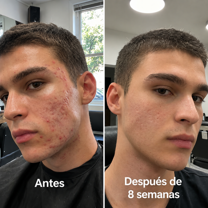 Stick Lumé ™ Elimina Acné y Enrojecimiento en pocos días + Ebook de regalo 🎁